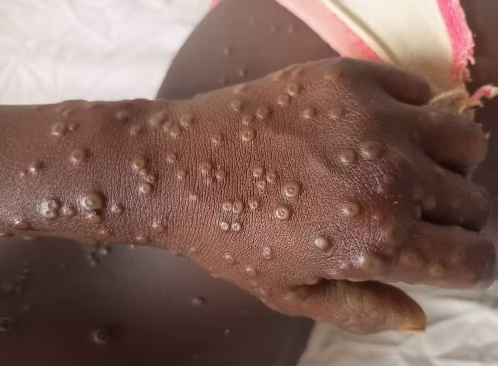 MPOX | L’AGENCE DE SANTÉ DE L’UNION AFRICAINE ALERTE SUR LA PROPAGATION DE LA VARIOLE DU SINGE