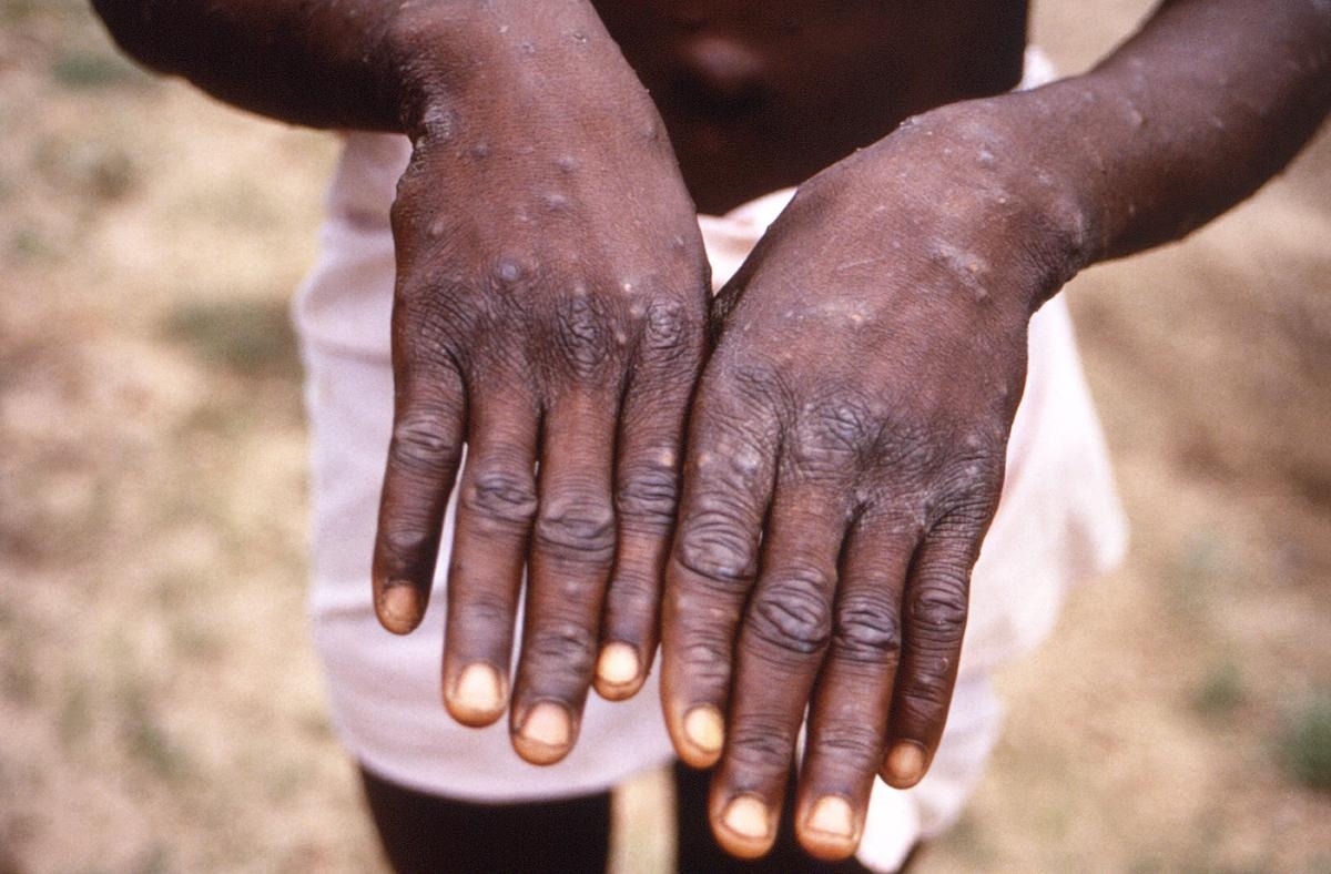 VARIOLE DU SINGE | « 53 CAS SUSPECTS ONT ÉTÉ RELEVÉS, TOUS SONT REVENUS NÉGATIFS » BOLY DIOP